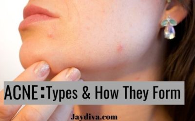 Different Types of Acne and How They Are Formed | Jaydiva