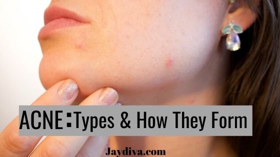 Different Types of Acne and How They Are Formed | Jaydiva