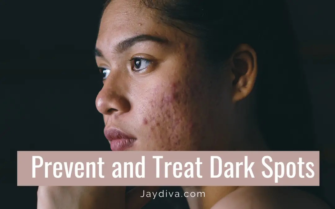 How to Prevent and Treat Post Inflammatory Hyperpigmentation on Dark Skin