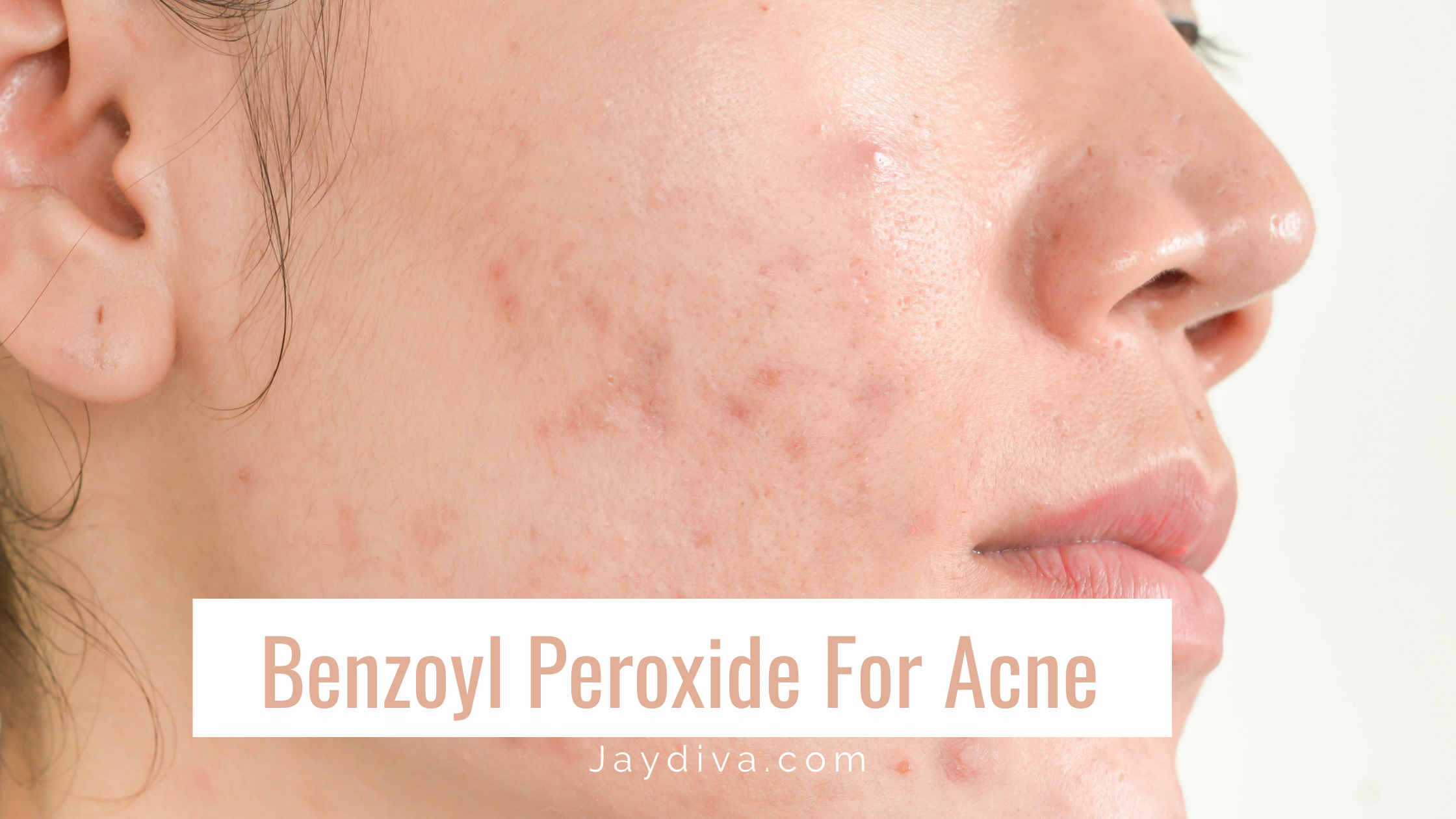 How to Use Benzoyl Peroxide for Acne to See Results
