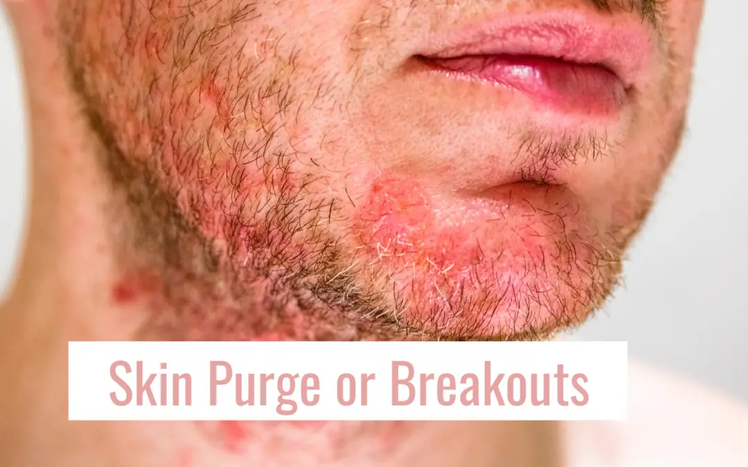 skin purging or breakouts