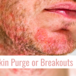 skin purging or breakouts