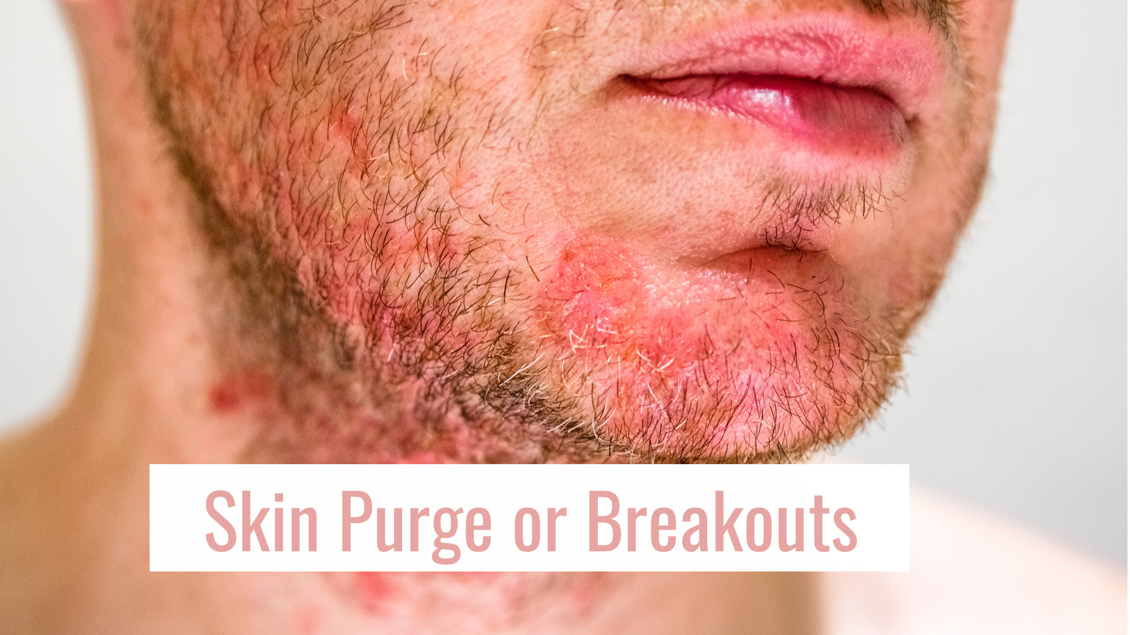 How to tell if your skin is purging or breaking out