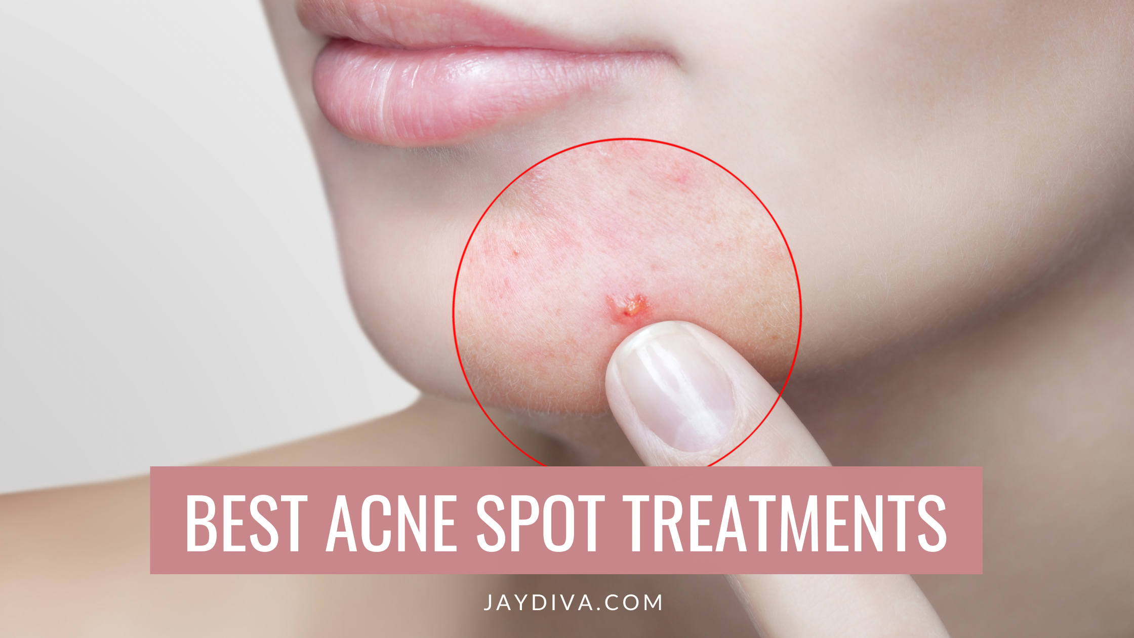 5 Best Overnight Acne Spot Treatments You Need To Try