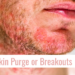 skin purging or breakouts