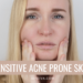 How to take care of sensitive acne prone skin