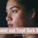 How to prevent and treat post inflammatory hyperpigmentation